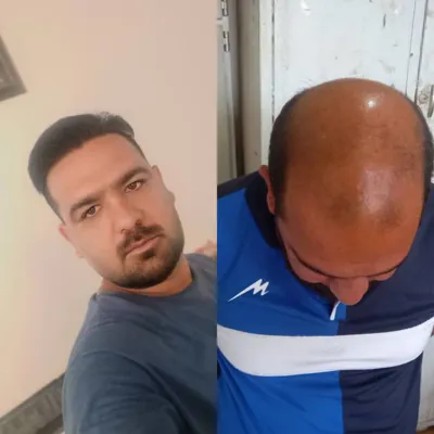 کاشت مو تضمینی در شیراز