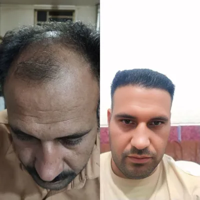 کاشت مو تضمینی در شیراز