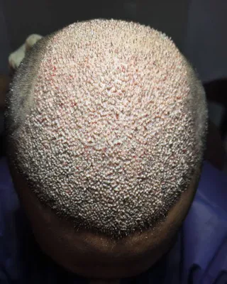 کاشت مو تضمینی در شیراز