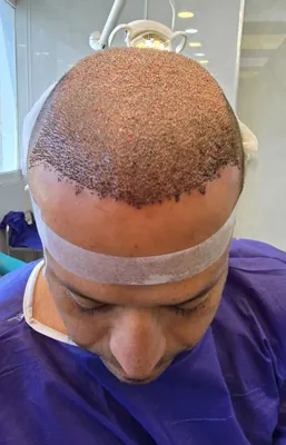 کاشت مو تضمینی در شیراز