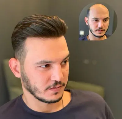 کاشت مو تضمینی در شیراز