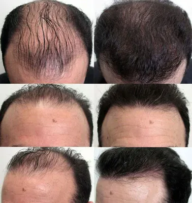 کاشت مو تضمینی در شیراز