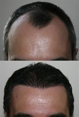 کاشت مو تضمینی در شیراز