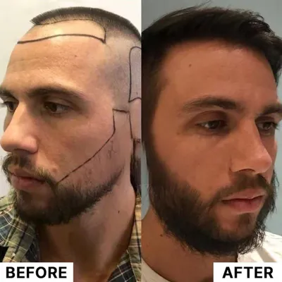 کاشت مو تضمینی در شیراز