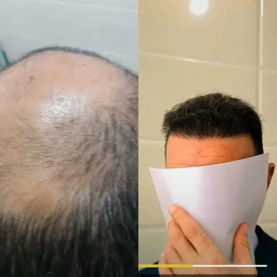 کاشت مو تضمینی در شیراز