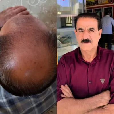 کاشت مو تضمینی در شیراز