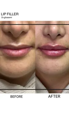 بهترین دکتر تزریق ژل لب در شیراز