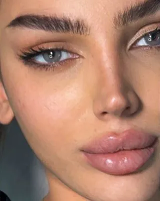 تزریق فیلر و بوتاکس در اصفهان