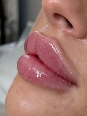 تزریق بوتاکس در اصفهان