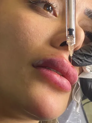 تزریق ژل و بوتاکس در هشت بهشت اصفهان