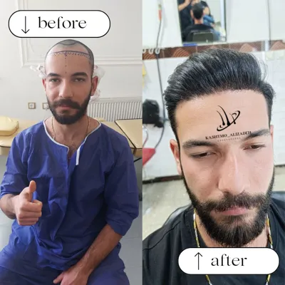 کاشت مو اقساطی در ارومیه