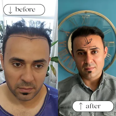 بهترین دکتر کاشت مو در ارومیه