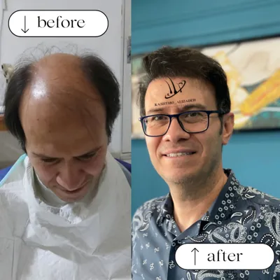 کاشت مو اقساطی در ارومیه