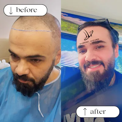 بهترین دکتر کاشت مو در ارومیه