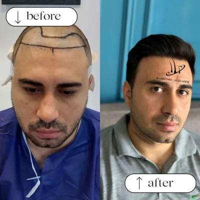 کاشت مو اقساطی در ارومیه