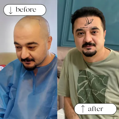 بهترین دکتر کاشت مو در ارومیه