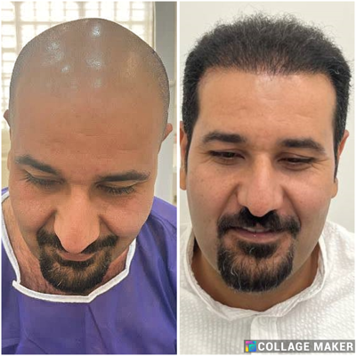 کلینیک کاشت مو یزد