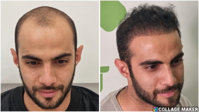 کلینیک کاشت مو یزد