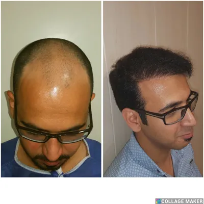 کلینیک کاشت مو یزد