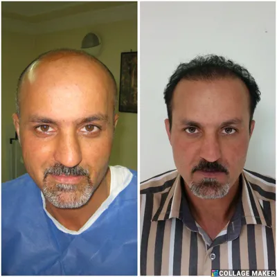 کلینیک کاشت مو یزد