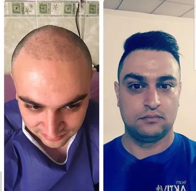 کلینیک کاشت مو یزد