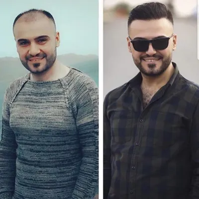 کلینیک کاشت مو یزد