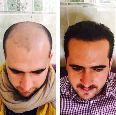 کلینیک کاشت مو یزد