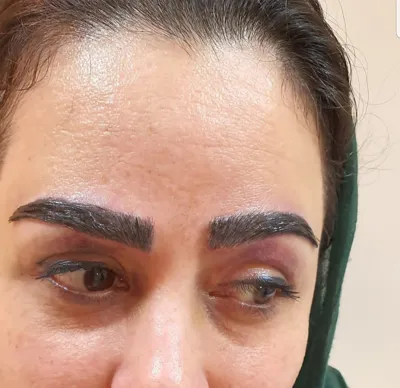 کلینیک کاشت موی آتیه