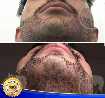 کلینیک کاشت موی آتیه