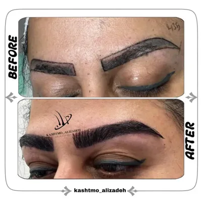 بهترین دکتر کاشت ابرو در ارومیه