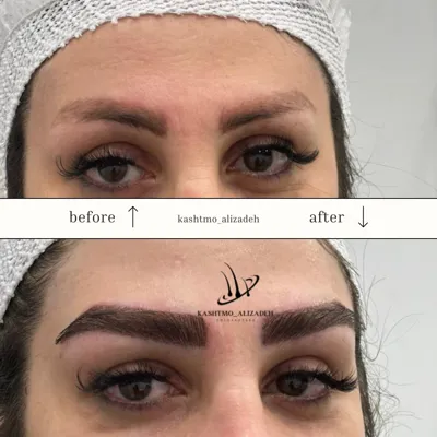 بهترین دکتر کاشت ابرو در ارومیه