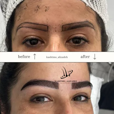 هزینه کاشت ابرو در ارومیه