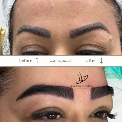 بهترین دکتر کاشت ابرو در ارومیه