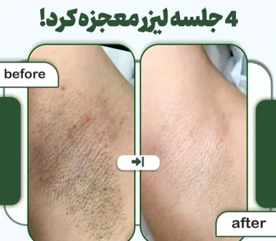 لیزر موهای زائد در اصفهان 