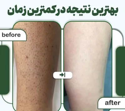 لیزر بدن در اصفهان 