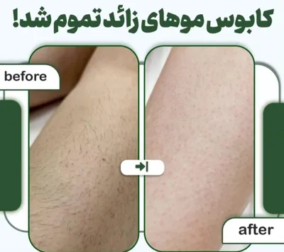 لیزر بدن در اصفهان 