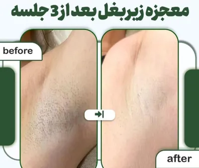 لیزر موهای زائد در اصفهان 