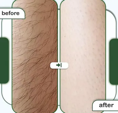 لیزر بدن در اصفهان 