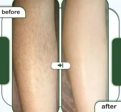 لیزر موهای زائد در اصفهان 