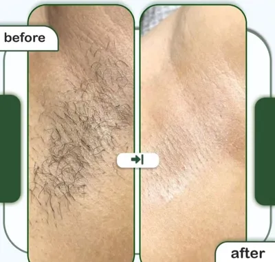 لیزر بدن در اصفهان 