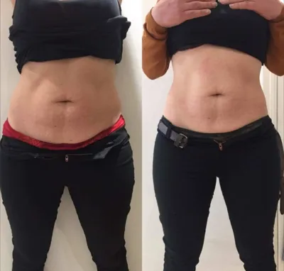 حجامت امبدینگ طب سوزنی در اصفهان 