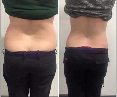 حجامت امبدینگ طب سوزنی در اصفهان 