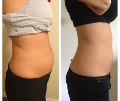 حجامت امبدینگ طب سوزنی در اصفهان 