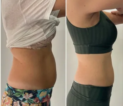 حجامت امبدینگ طب سوزنی در اصفهان 