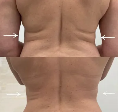 حجامت امبدینگ طب سوزنی در اصفهان 