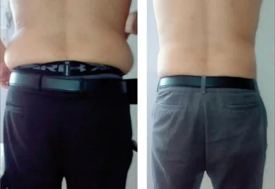 حجامت امبدینگ طب سوزنی در اصفهان 