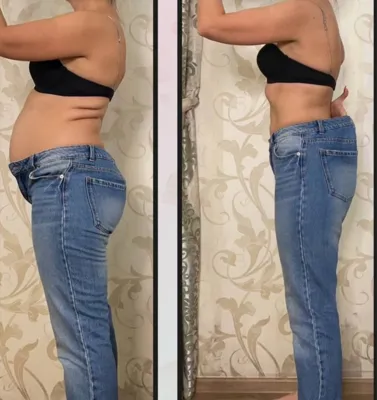 حجامت امبدینگ طب سوزنی در اصفهان 