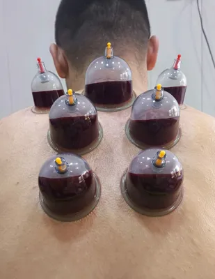 حجامت امبدینگ طب سوزنی در اصفهان 