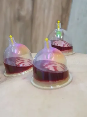 حجامت امبدینگ طب سوزنی در اصفهان 