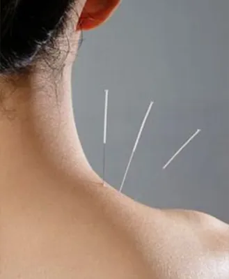 حجامت امبدینگ طب سوزنی در اصفهان 